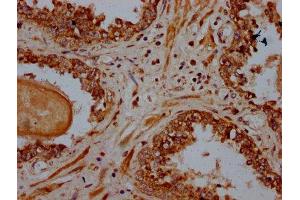 IHC image of ABIN7164923 diluted at 1:600 and staining in paraffin-embedded human prostate cancer performed on a Leica BondTM system. (PSME4 anticorps  (AA 105-198))
