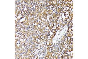 Immunohistochemistry of paraffin-embedded Human hepatocellular carcinoma using β-Catenin antibody (ABIN7266137) at dilution of 1:100 (40x lens).