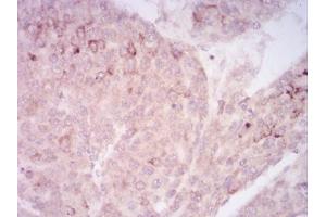 Immunohistochemical analysis of paraffin-embedded ovarian cancer tissues using SIRT7 mouse mAb with DAB staining.