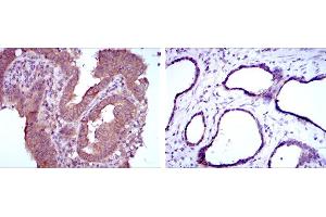 Immunohistochemical analysis of paraffin-embedded intima cancer tissues (left) and prostate tissues (right) using MTHFR mouse mAb with DAB staining.