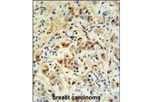 mouse BID Antibody (S61)IHC analysis in formalin fixed and paraffin embedded human breast carcinoma followed by peroxidase conjugation of the secondary antibody and DAB staining. (BID anticorps  (AA 39-68))