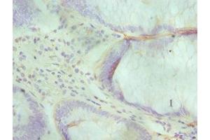 Immunohistochemistry of paraffin-embedded human colon cancer using ABIN7143716 at dilution of 1:100