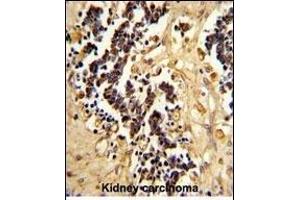 Formalin-fixed and paraffin-embedded human kidney carcinoma reacted with EHD3 Antibody (Center), which was peroxidase-conjugated to the secondary antibody, followed by DAB staining. (EHD3 anticorps  (AA 189-216))