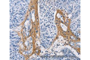 Immunohistochemistry of Human cervical cancer using COL3A1 Polyclonal Antibody at dilution of 1:60 (COL3A1 anticorps)