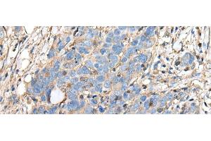 Immunohistochemistry of paraffin-embedded Human thyroid cancer tissue using PLA2G16 Polyclonal Antibody at dilution of 1:40(x200) (PLA2G16 anticorps)
