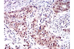 Immunohistochemical analysis of paraffin-embedded cervical cancer tissues using ONECUT3 mouse mAb with DAB staining.