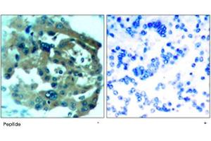 Immunohistochemical analysis of paraffin-embedded human lung carcinoma tissue using NF2 polyclonal antibody . (Merlin anticorps)