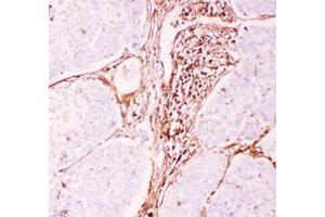 Immunohistochemical staining (Formalin-fixed paraffin-embedded sections) of human lung cancer tissue with ABCB1 polyclonal antibody  under 0.