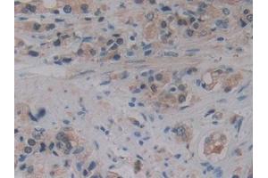 Detection of 15-LO-2 in Human Prostate cancer Tissue using Polyclonal Antibody to 15-Lipoxygenase-2 (15-LO-2) (ALOX15B anticorps  (AA 253-490))