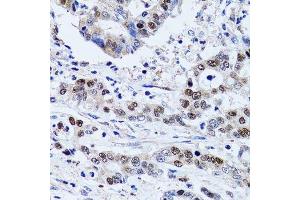 Immunohistochemistry of paraffin-embedded human colon carcinoma using UHRF1 antibody.