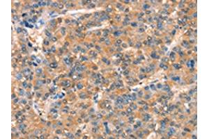 The image on the left is immunohistochemistry of paraffin-embedded Human liver cancer tissue using ABIN7189890(ARHGAP4 Antibody) at dilution 1/25, on the right is treated with synthetic peptide. (ARHGAP4 anticorps)
