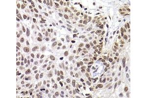 Immunohistochemistry of paraffin-embedded Human well-differentiated squamous skin carcinoma using PHIP Polyclonal Antibody at dilution of 1:100 (40x lens).