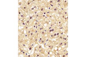 (ABIN6242522 and ABIN6577190) staining PGK1 in human liver tissue sections by Immunohistochemistry (IHC-P - paraformaldehyde-fixed, paraffin-embedded sections). (PGK1 anticorps  (AA 1-417))