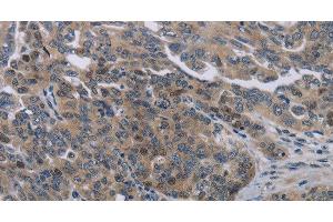 Immunohistochemistry of paraffin-embedded Human ovarian cancer tissue using NOX1 Polyclonal Antibody at dilution 1:50 (NOX1 anticorps)