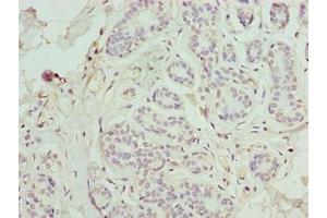 Immunohistochemistry of paraffin-embedded human breast cancer using ABIN7165550 at dilution of 1:100 (FAM71F1 anticorps  (AA 121-343))