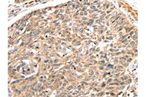 The image on the left is immunohistochemistry of paraffin-embedded Human lung cancer tissue using ABIN7191289(LONP1 Antibody) at dilution 1/25, on the right is treated with synthetic peptide. (LONP1 anticorps)