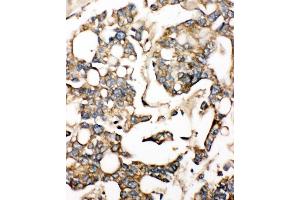 Anti-SLC10A1 antibody, IHC(P) IHC(P): Human Liver Cancer Tissue