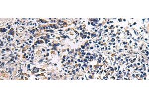 Immunohistochemistry of paraffin-embedded Human breast cancer tissue using DRGX Polyclonal Antibody at dilution of 1:45(x200) (DRGX anticorps)
