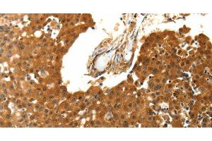 Immunohistochemistry of paraffin-embedded Human breast cancer using SKP1 Polyclonal Antibody at dilution of 1:30 (SKP1 anticorps)