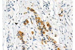 ABIN6262693 and ABIN6273257 at 1/100 staining Human pancreatic cancer by IHC-P. (ITLN1/Omentin anticorps  (C-Term))