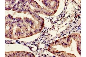 Immunohistochemistry of paraffin-embedded human endometrial cancer using ABIN7161170 at dilution of 1:100 (SYNE2 anticorps  (AA 1-176))