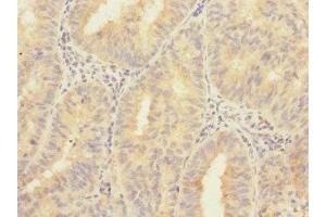 Immunohistochemistry of paraffin-embedded human endometrial cancer using ABIN7176401 at dilution of 1:100 (ZNF582 anticorps  (AA 1-300))