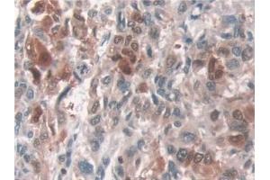 Detection of ATP7b in Human Liver cancer Tissue using Polyclonal Antibody to ATPase, Cu++ Transporting Beta Polypeptide (ATP7b)