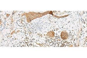 Immunohistochemistry of paraffin-embedded Human esophagus cancer tissue using GSTM2 Polyclonal Antibody at dilution of 1:50(x200) (GSTM2 anticorps)