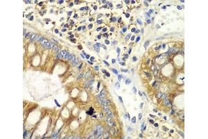 Immunohistochemistry of paraffin-embedded Human colon using PICK1 Polyclonal Antibody at dilution of 1:100 (40x lens). (PICK1 anticorps)