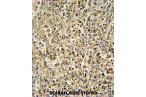 RNT2 antibody (N-term) immunohistochemistry analysis in formalin fixed and paraffin embedded human spleen carcinoma followed by peroxidase conjugation of the secondary antibody and DAB staining.