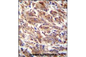 FBXW12 antibody immunohistochemistry analysis in formalin fixed and paraffin embedded human breast carcinoma followed by peroxidase conjugation of the secondary antibody and DAB staining.
