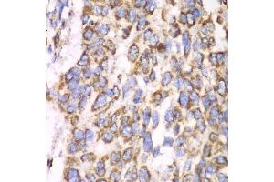 Immunohistochemistry of paraffin-embedded human esophageal cancer using ATP5A1 antibody. (ATP5A1 anticorps)