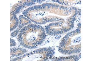 Immunohistochemistry of Human colon cancer using GNAZ Polyclonal Antibody at dilution of 1:25