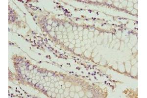 Immunohistochemistry of paraffin-embedded human colon cancer using ABIN7159525 at dilution of 1: 100 (MT1G anticorps  (AA 1-59))