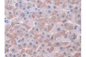 Detection of CDK2 in Human Liver cancer Tissue using Polyclonal Antibody to Cyclin Dependent Kinase 2 (CDK2)