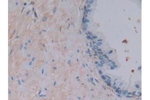 Detection of FTL in Human Prostate Tissue using Polyclonal Antibody to Ferritin, Light Polypeptide (FTL)