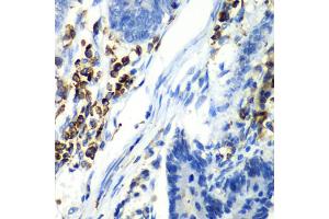 Immunohistochemistry of paraffin-embedded human colon carcinoma using ASGR1 antibody. (Asialoglycoprotein Receptor 1 anticorps)