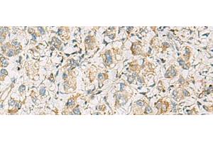 Immunohistochemistry of paraffin-embedded Human liver cancer tissue using PDE4DIP Polyclonal Antibody at dilution of 1:60(x200) (PDE4DIP anticorps)
