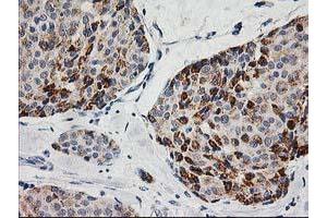 Immunohistochemical staining of paraffin-embedded Adenocarcinoma of Human breast tissue using anti-AK4 mouse monoclonal antibody. (AK4 anticorps)