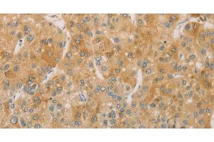 Immunohistochemistry of paraffin-embedded Human liver cancer using ACSL4 Polyclonal Antibody at dilution of 1:60 (ACSL4 anticorps)