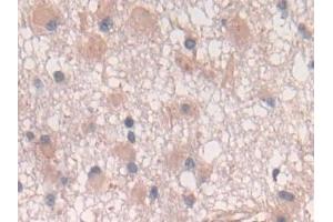 Detection of IL10 in Human Glioma Tissue using Polyclonal Antibody to Interleukin 10 (IL10) (IL-10 anticorps  (AA 19-178))