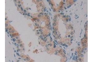 Detection of SDH in Human Prostate Tissue using Polyclonal Antibody to Sorbitol Dehydrogenase (SDH)