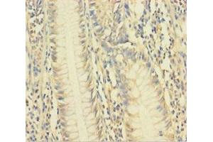 Immunohistochemistry of paraffin-embedded human colon cancer using ABIN7175481 at dilution of 1:100