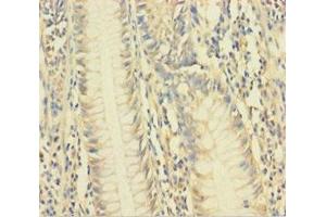 Immunohistochemistry of paraffin-embedded human colon cancer using ABIN7175481 at dilution of 1:100 (VAMP5 anticorps  (AA 1-72))