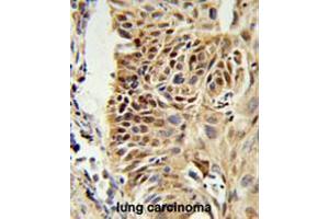 CIRBP Antibody (C-term) IHC analysis in formalin fixed and paraffin embedded human lung carcinoma followed by peroxidase conjugation of the secondary antibody and DAB staining. (CIRBP anticorps  (C-Term))