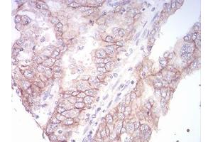 Immunohistochemical analysis of paraffin-embedded endometrial cancer tissues using SK2 mouse mAb with DAB staining.