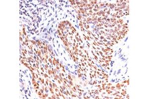 IHC staining of lung squamous cell carcinoma with p40 antibody. (p40 (p63 Delta) (AA 5-17) anticorps)