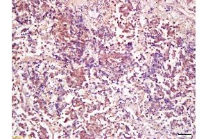 Formalin-fixed and paraffin embedded human lung carcinoma labeled with Anti-PP2A alpha + beta Polyclonal Antibody, Unconjugated (ABIN723875) at 1:200 followed by conjugation to the secondary antibody and DAB staining (PP2A alpha/beta anticorps  (AA 205-309))