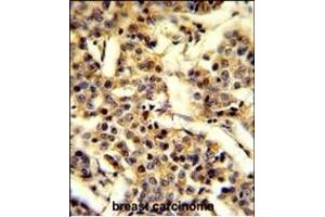 Formalin-fixed and paraffin-embedded human breast carcinoma reacted with CYP2A13 Antibody (C-term), which was peroxidase-conjugated to the secondary antibody, followed by DAB staining. (CYP2A13 anticorps  (C-Term))