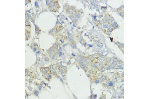 Immunohistochemistry of paraffin-embedded human mammary cancer using SOCS6 antibody (ABIN6128785, ABIN6148273, ABIN6148274 and ABIN6225294) at dilution of 1:100 (40x lens). (SOCS6 anticorps  (AA 1-210))